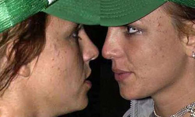 britneyspears_acne
